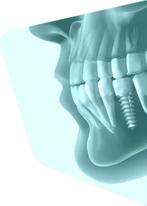implant machoire