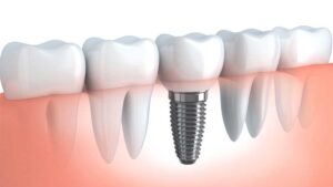 implants dentaire
